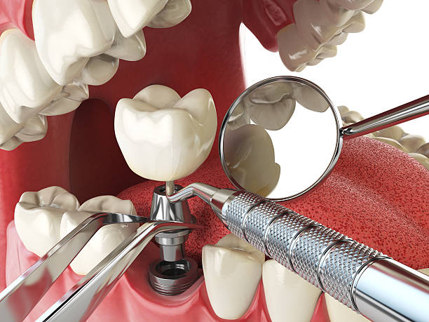 Best Emergency Root Canal Treatment in Morris, IL